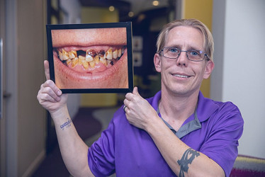 Full Mouth Dental Implants | Dentist | Fort Worth, Texas